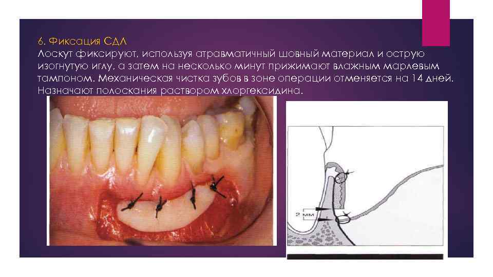 6. Фиксация СДЛ Лоскут фиксируют, используя атравматичный шовный материал и острую изогнутую иглу, а