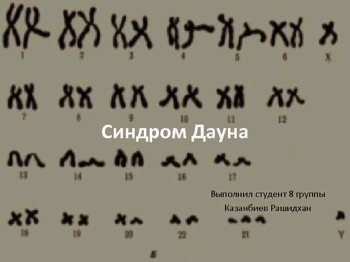 Синдром дауна причины. Синдром Дауна презентация. Причины появления синдрома Дауна. Синдром Дауна патофизиология.