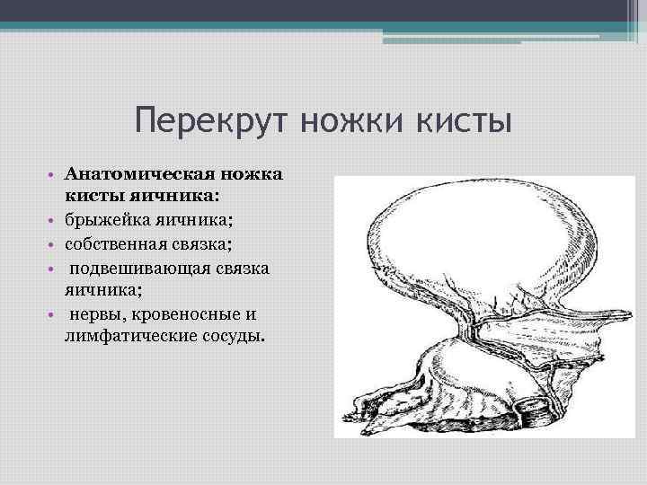 Перекрут ножки кисты • Анатомическая ножка кисты яичника: • брыжейка яичника; • собственная связка;