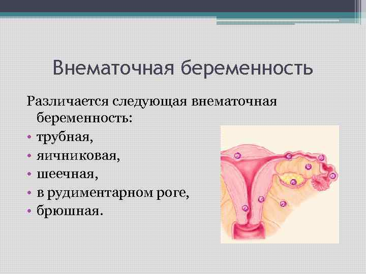 Внематочная беременность Различается следующая внематочная беременность: • трубная, • яичниковая, • шеечная, • в