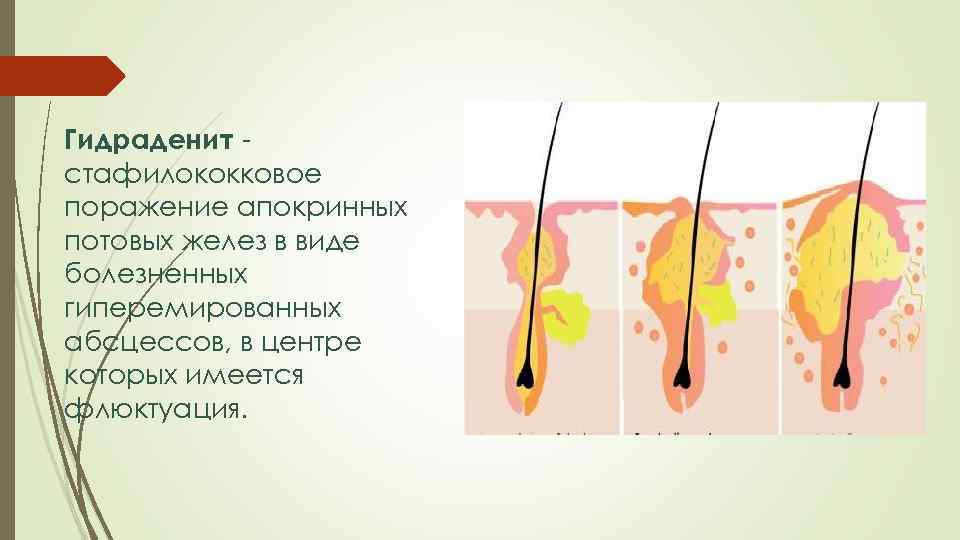 Гидраденит стафилококковое поражение апокринных потовых желез в виде болезненных гиперемированных абсцессов, в центре которых