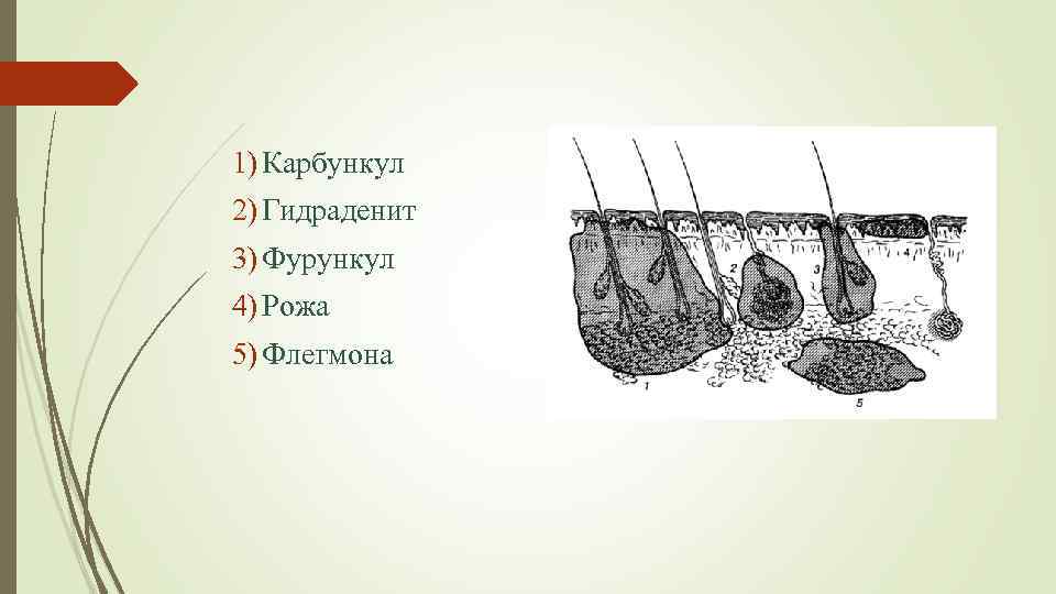 1) Карбункул 2) Гидраденит 3) Фурункул 4) Рожа 5) Флегмона 