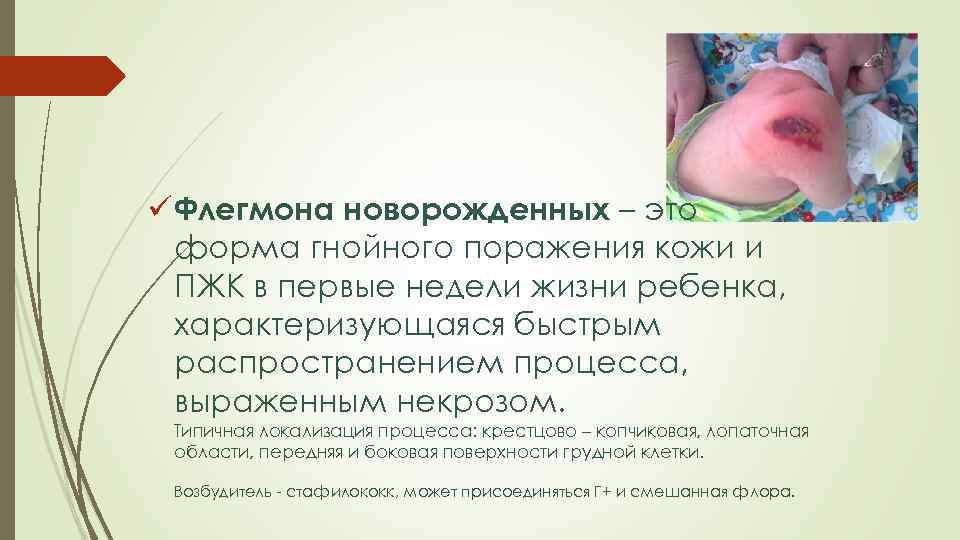 ü Флегмона новорожденных – это форма гнойного поражения кожи и ПЖК в первые недели