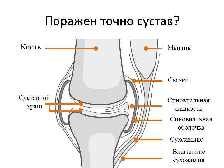 Поражен точно сустав? 