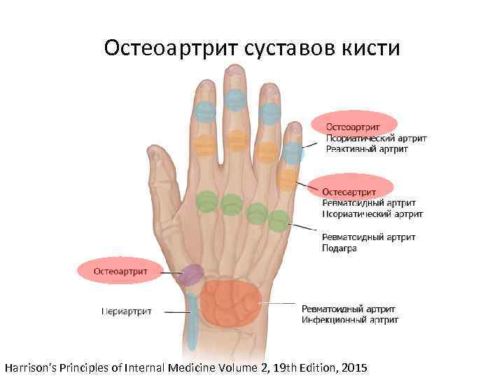 Остеоартрит суставов кисти Harrison's Principles of Internal Medicine Volume 2, 19 th Edition, 2015