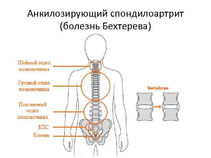 Анкилозирующий спондилоартрит (болезнь Бехтерева) 