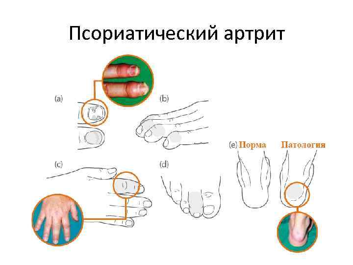 Псориатический артрит 