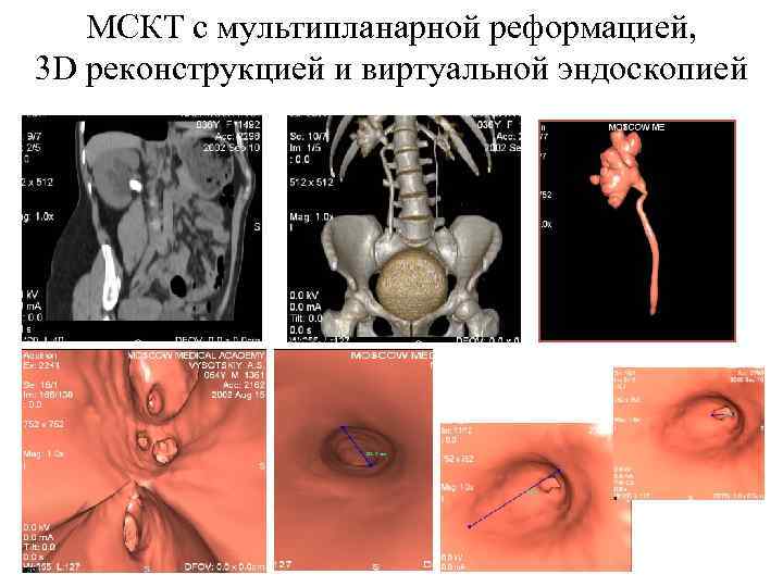 МСКТ с мультипланарной реформацией, 3 D реконструкцией и виртуальной эндоскопией 
