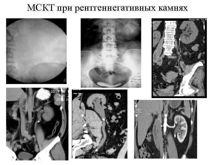 МСКТ при рентгеннегативных камнях 
