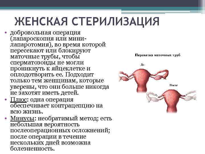 ЖЕНСКАЯ СТЕРИЛИЗАЦИЯ • добровольная операция (лапароскопия или минилапаротомия), во время которой пересекают или блокируют