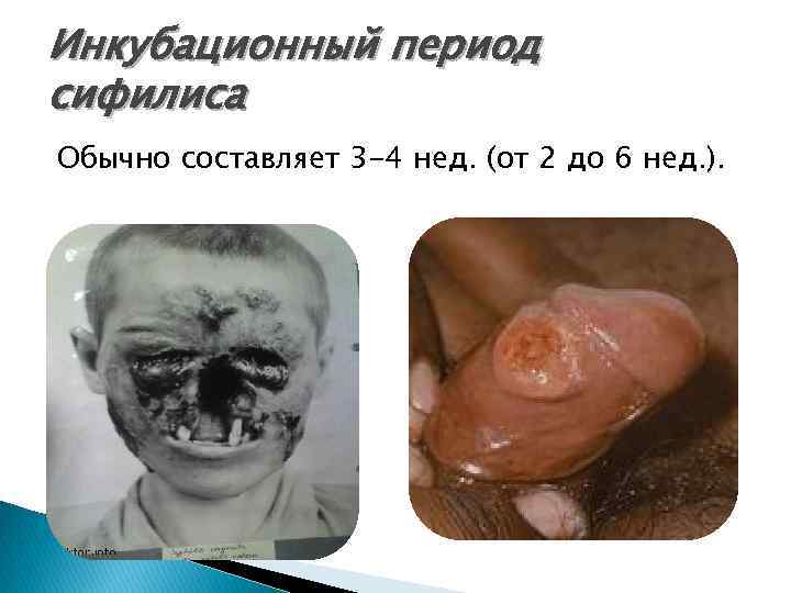 Инкубационный период сифилиса Обычно составляет 3 -4 нед. (от 2 до 6 нед. ).