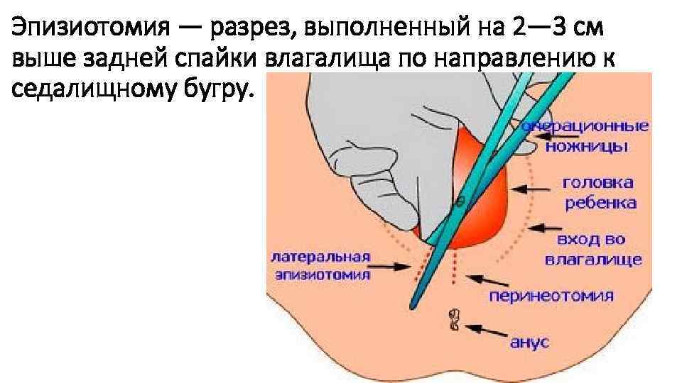 Эпизиотомия — разрез, выполненный на 2— 3 см выше задней спайки влагалища по направлению