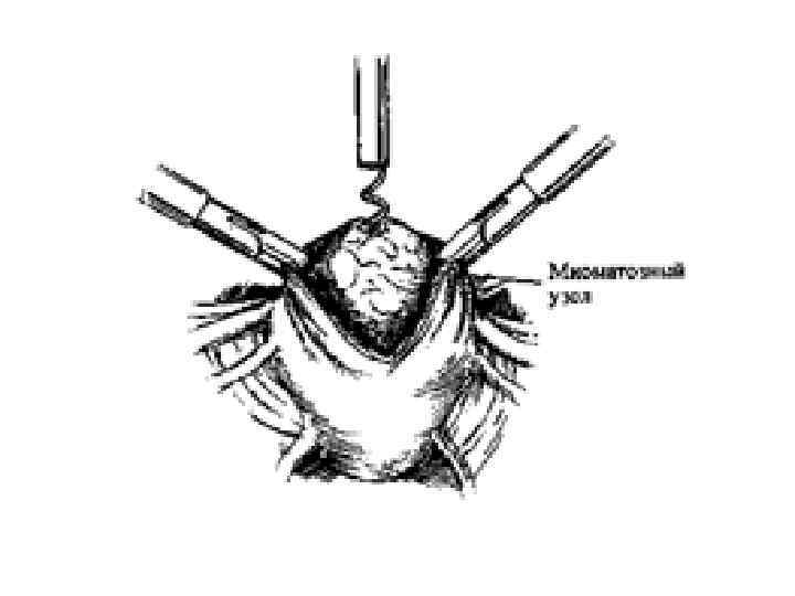 Наркоз матки. Миомэктомия энуклеация. Лапароскопическая миомэктомия. Лапаротомия миомэктомия.