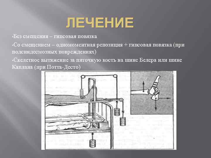 ЛЕЧЕНИЕ • Без смещения – гипсовая повязка • Со смещением – одномоментная репозиция +