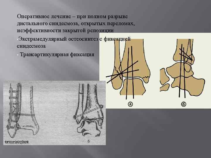 Разрыв дистального межберцового синдесмоза