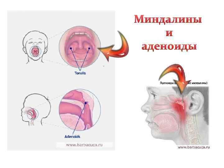 Миндалины и аденоиды 