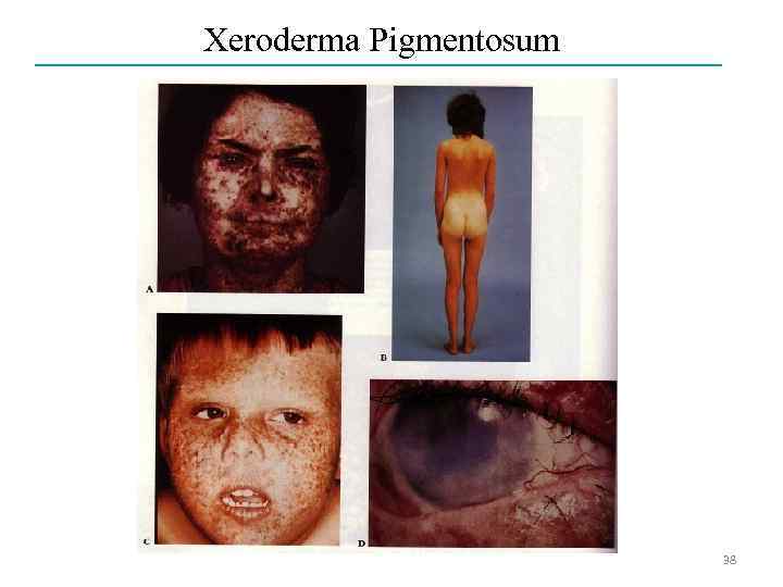 Xeroderma Pigmentosum 38 