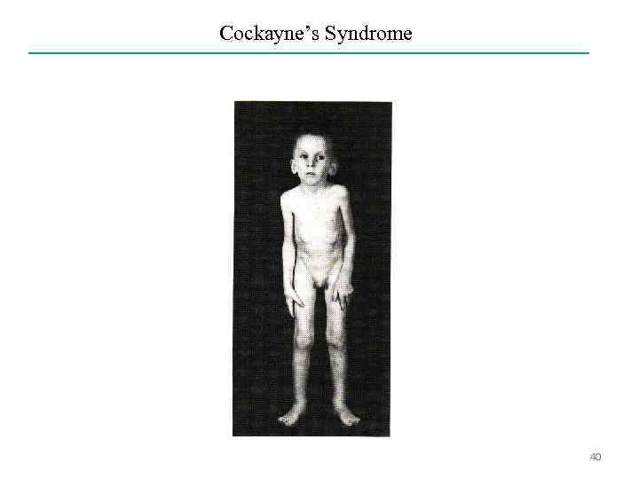 Cockayne’s Syndrome 40 