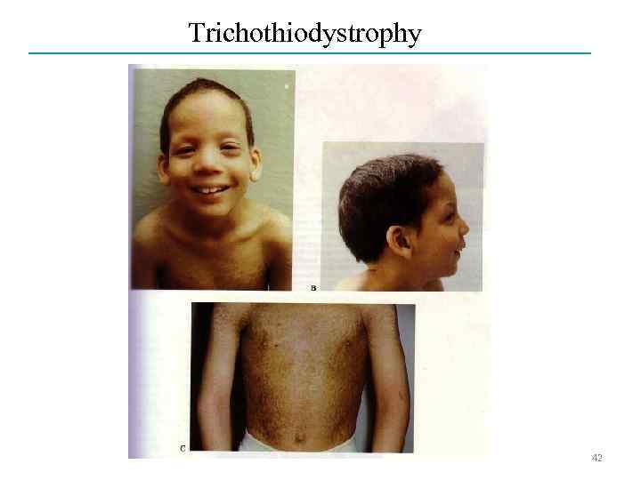 Trichothiodystrophy 42 