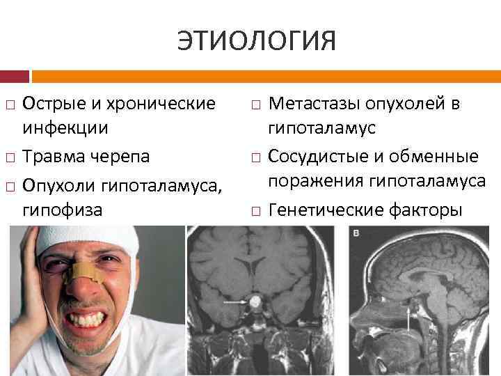 ЭТИОЛОГИЯ Острые и хронические инфекции Травма черепа Опухоли гипоталамуса, гипофиза Метастазы опухолей в гипоталамус