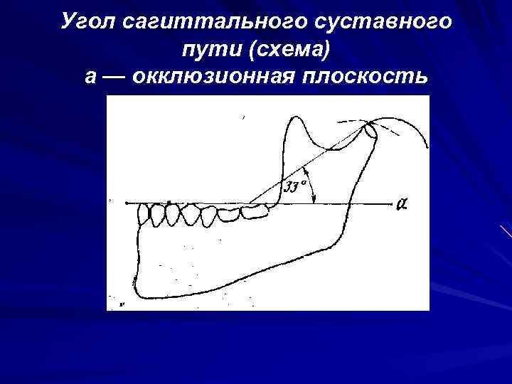 Угол сагиттального суставного пути (схема) а — окклюзионная плоскость 