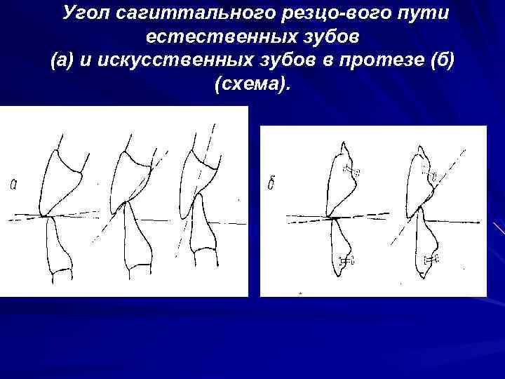 Угол сагиттального резцо вого пути естественных зубов (а) и искусственных зубов в протезе (б)