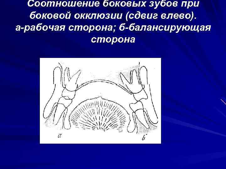 Соотношение боковых зубов при боковой окклюзии (сдвиг влево). а рабочая сторона; б балансирующая сторона