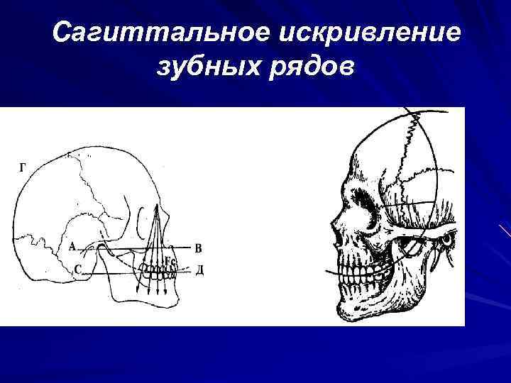 Сагиттальное искривление зубных рядов 