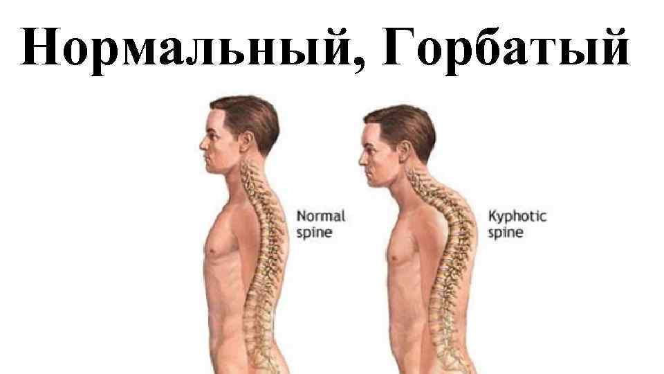 Кифотическая установка шейного отдела