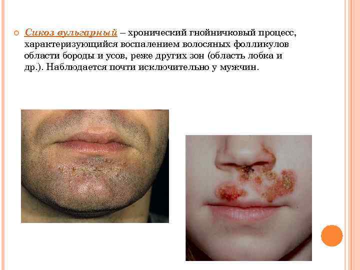  Сикоз вульгарный – хронический гнойничковый процесс, характеризующийся воспалением волосяных фолликулов области бороды и
