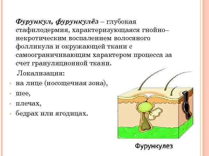  • • Фурункул, фурункулёз – глубокая стафилодермия, характеризующаяся гнойно– некротическим воспалением волосяного фолликула