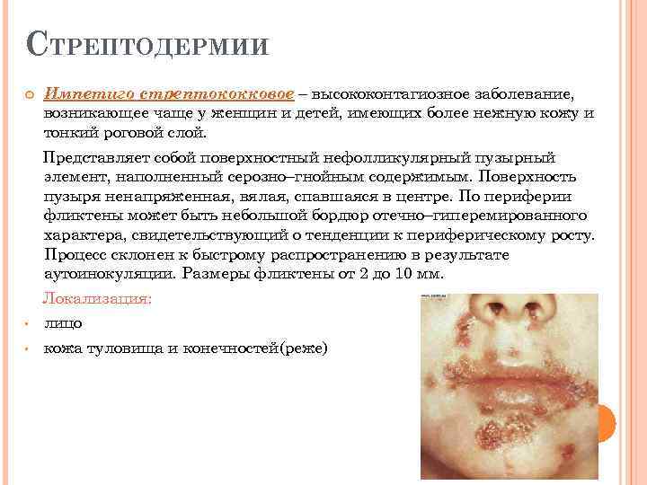СТРЕПТОДЕРМИИ Импетиго стрептококковое – высококонтагиозное заболевание, возникающее чаще у женщин и детей, имеющих более