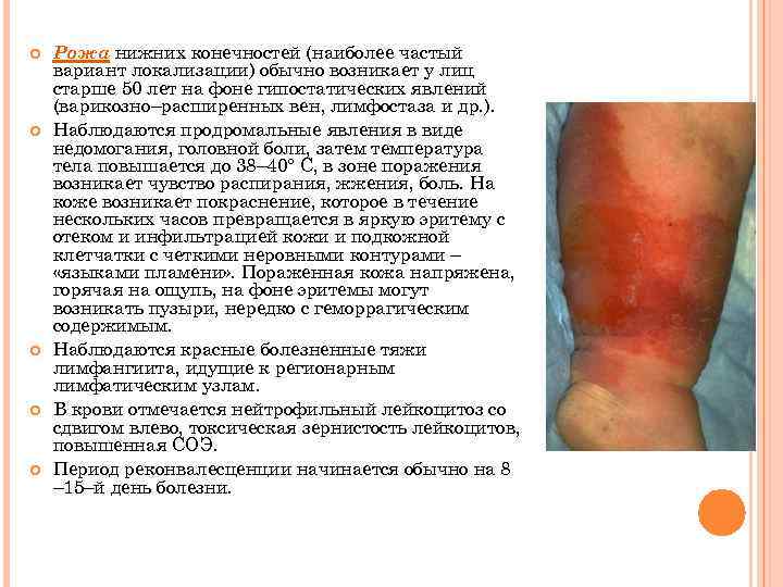  Рожа нижних конечностей (наиболее частый вариант локализации) обычно возникает у лиц старше 50