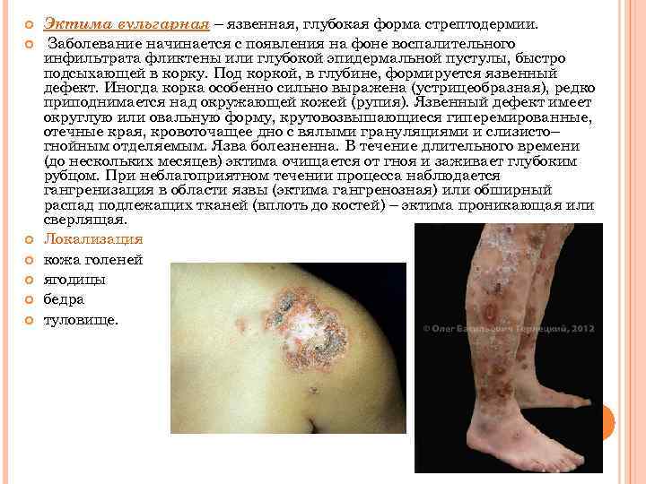  Эктима вульгарная – язвенная, глубокая форма стрептодермии. Заболевание начинается с появления на фоне