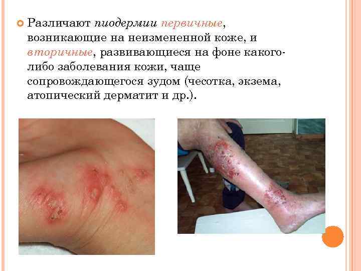  Различают пиодермии первичные, возникающие на неизмененной коже, и вторичные, развивающиеся на фоне какоголибо