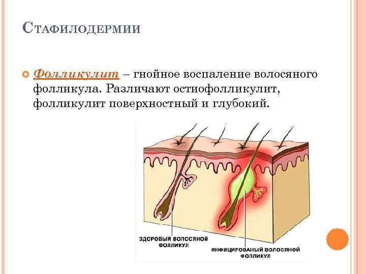 СТАФИЛОДЕРМИИ Фолликулит – гнойное воспаление волосяного фолликула. Различают остиофолликулит, фолликулит поверхностный и глубокий. 