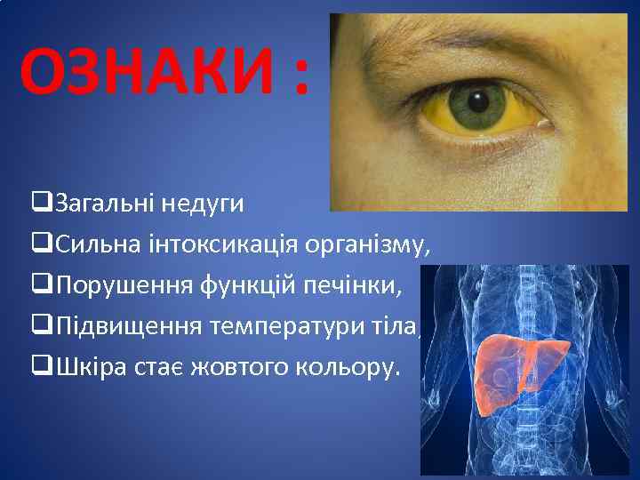 ОЗНАКИ : q. Загальні недуги q. Сильна інтоксикація організму, q. Порушення функцій печінки, q.