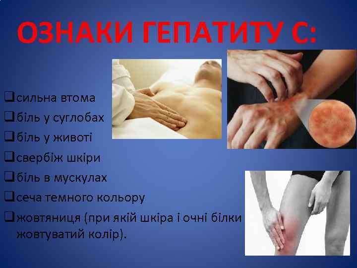 ОЗНАКИ ГЕПАТИТУ С: q сильна втома q біль у суглобах q біль у животі