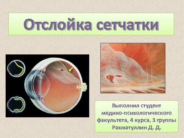 Отслойка сетчатки презентация