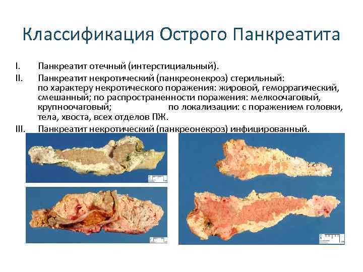 Классификация Острого Панкреатита I. II. III. Панкреатит отечный (интерстициальный). Панкреатит некротический (панкреонекроз) стерильный: по