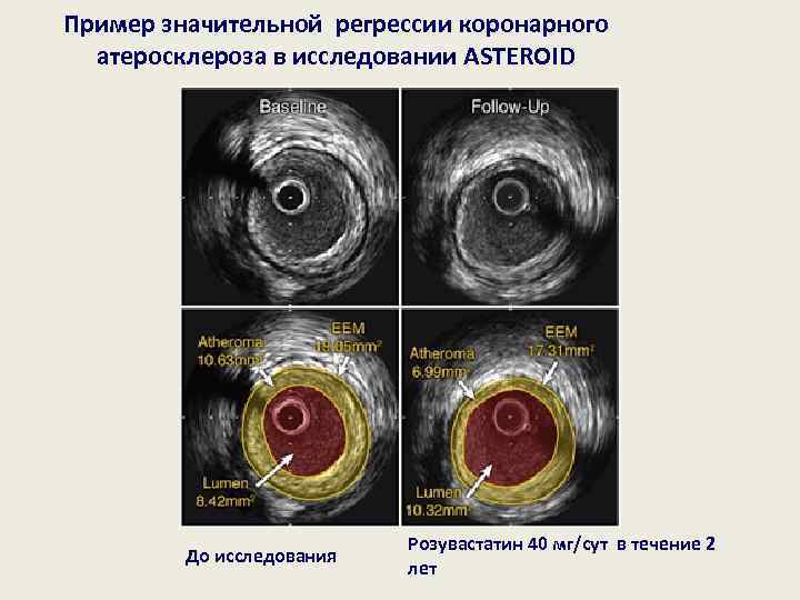 Пример значительной регрессии коронарного атеросклероза в исследовании ASTEROID До исследования Розувастатин 40 мг/сут в