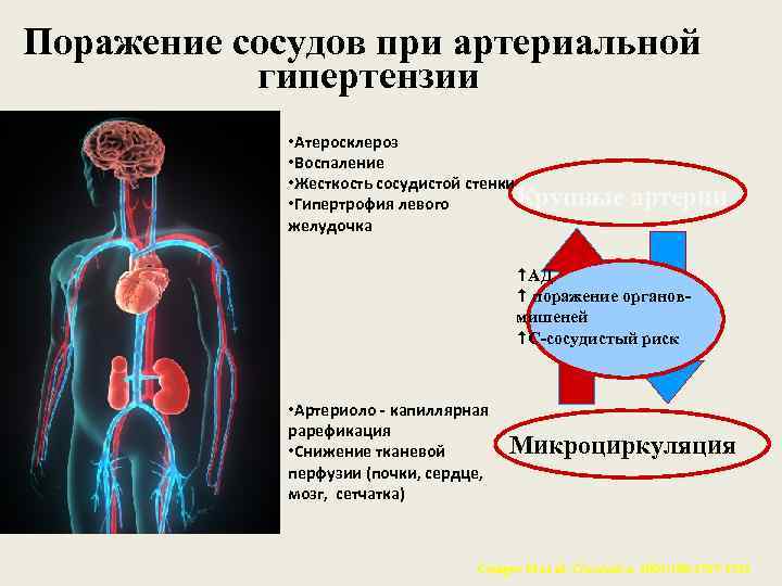 Поражение сосудов при артериальной гипертензии • Атеросклероз • Воспаление • Жесткость сосудистой стенки Крупные