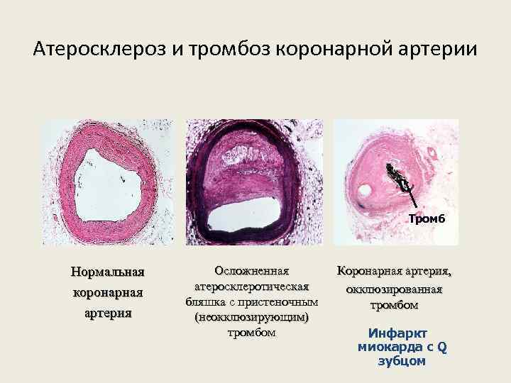 Атеросклероз и тромбоз коронарной артерии Тромб Нормальная коронарная артерия Осложненная атеросклеротическая бляшка с пристеночным