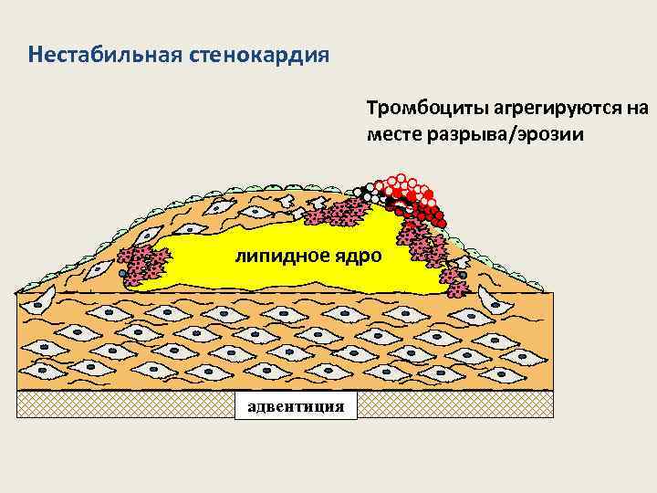 Нестабильная стенокардия Тромбоциты агрегируются на месте разрыва/эрозии lipid core липидное ядро адвентиция 