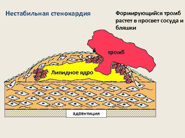 Нестабильная стенокардия Формирующийся тромб растет в просвет сосуда и бляшки тромб lipid core Липидное