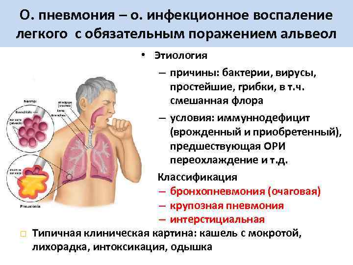 О. пневмония – о. инфекционное воспаление легкого с обязательным поражением альвеол • Этиология –