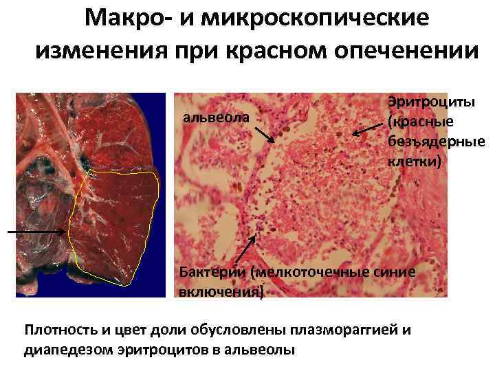 Макро- и микроскопические изменения при красном опеченении альвеола Эритроциты (красные безъядерные клетки) Бактерии (мелкоточечные