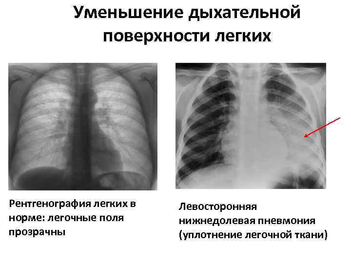 Уменьшение дыхательной поверхности легких Рентгенография легких в норме: легочные поля прозрачны Левосторонняя нижнедолевая пневмония