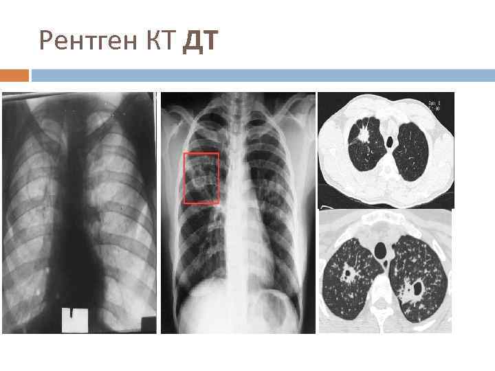 Туберкулез как выглядит фото. Диссеминированный кавернозный туберкулез кт. Инфильтративный туберкулез рентген кт. Инфильтративный туберкулез правого легкого кт. Инфильтративный туберкулез с распадом на кт.