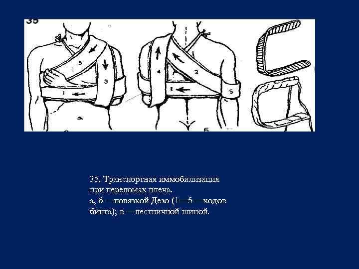 Иммобилизация лонгетой. Иммобилизация при переломе плеча шиной Крамера алгоритм. Иммобилизация при переломе плечевой кости. Перелом плечевой кости карта СМП.